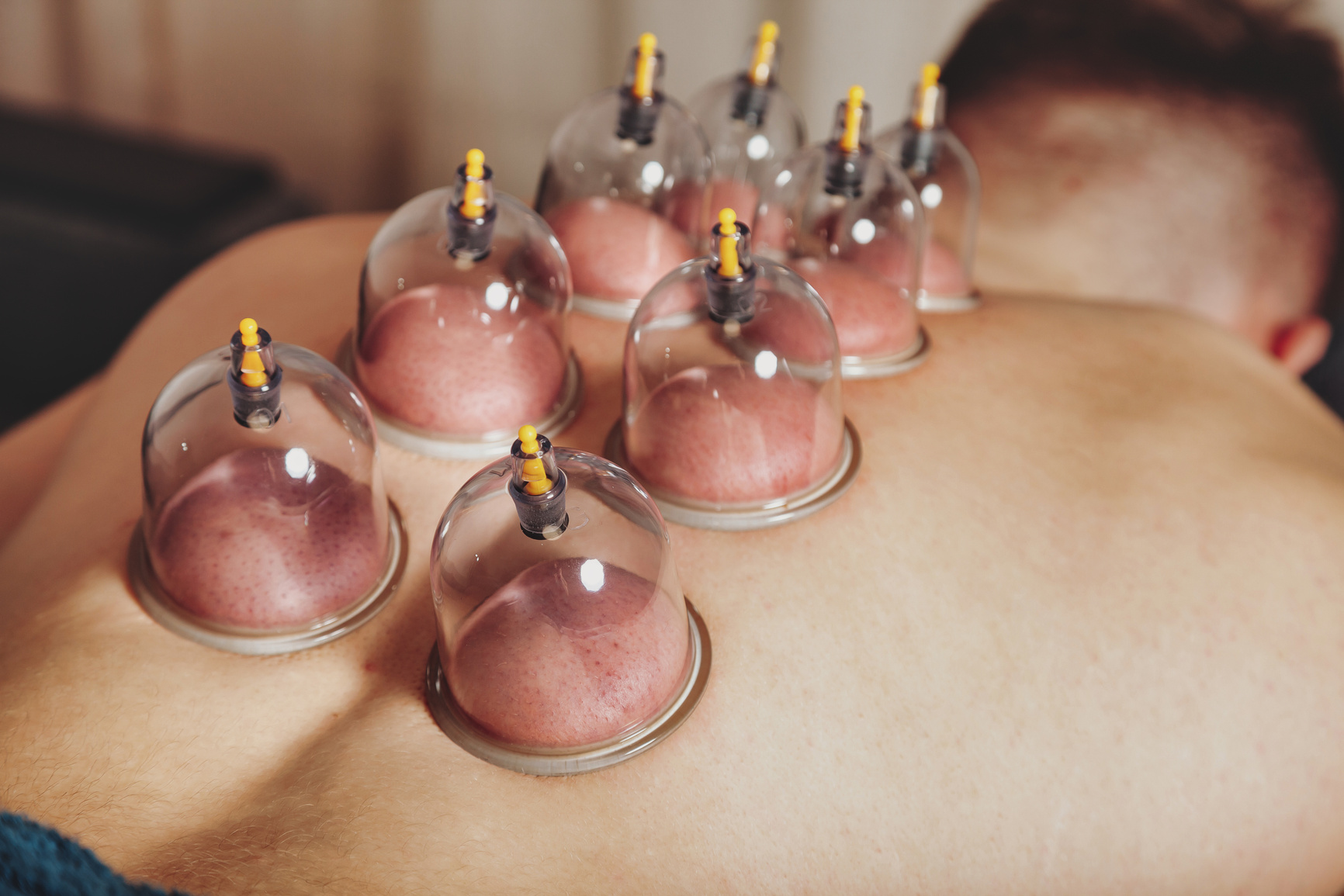 Close-up for multiple vacuum cups, medical cupping therapy